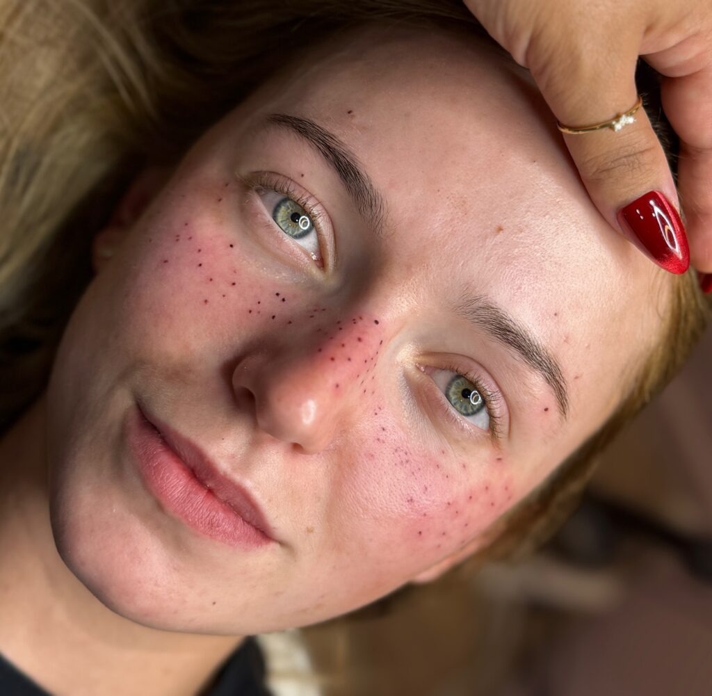 Freshly Inked Freckles Tattoo with Healing Effect Tattoo Design